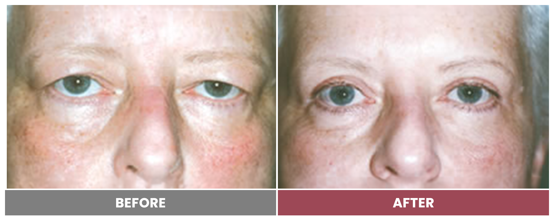 Upper Blepharoplasty - Case 62